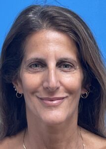 Blepharoplasty Before & After Pictures near Fort Lauderdale, FL