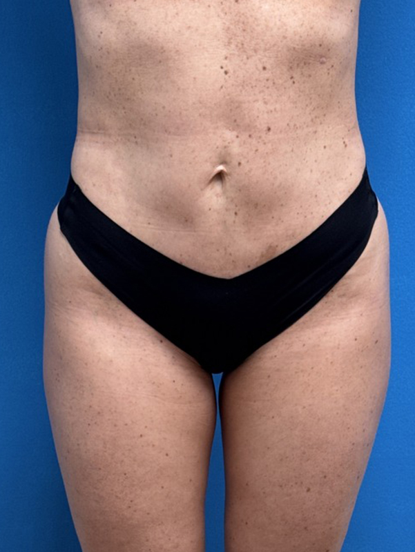 02272025 144100 (2) Mini Tummy Tuck Before & After Pictures near Fort Lauderdale, FL