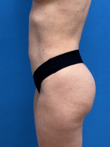 Plastic Surgery Before & After Pictures near Fort Lauderdale, FL