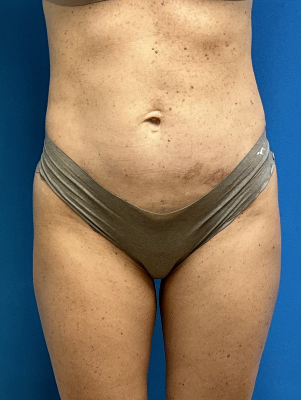 09062024 134400 Mini Tummy Tuck Before & After Pictures near Fort Lauderdale, FL
