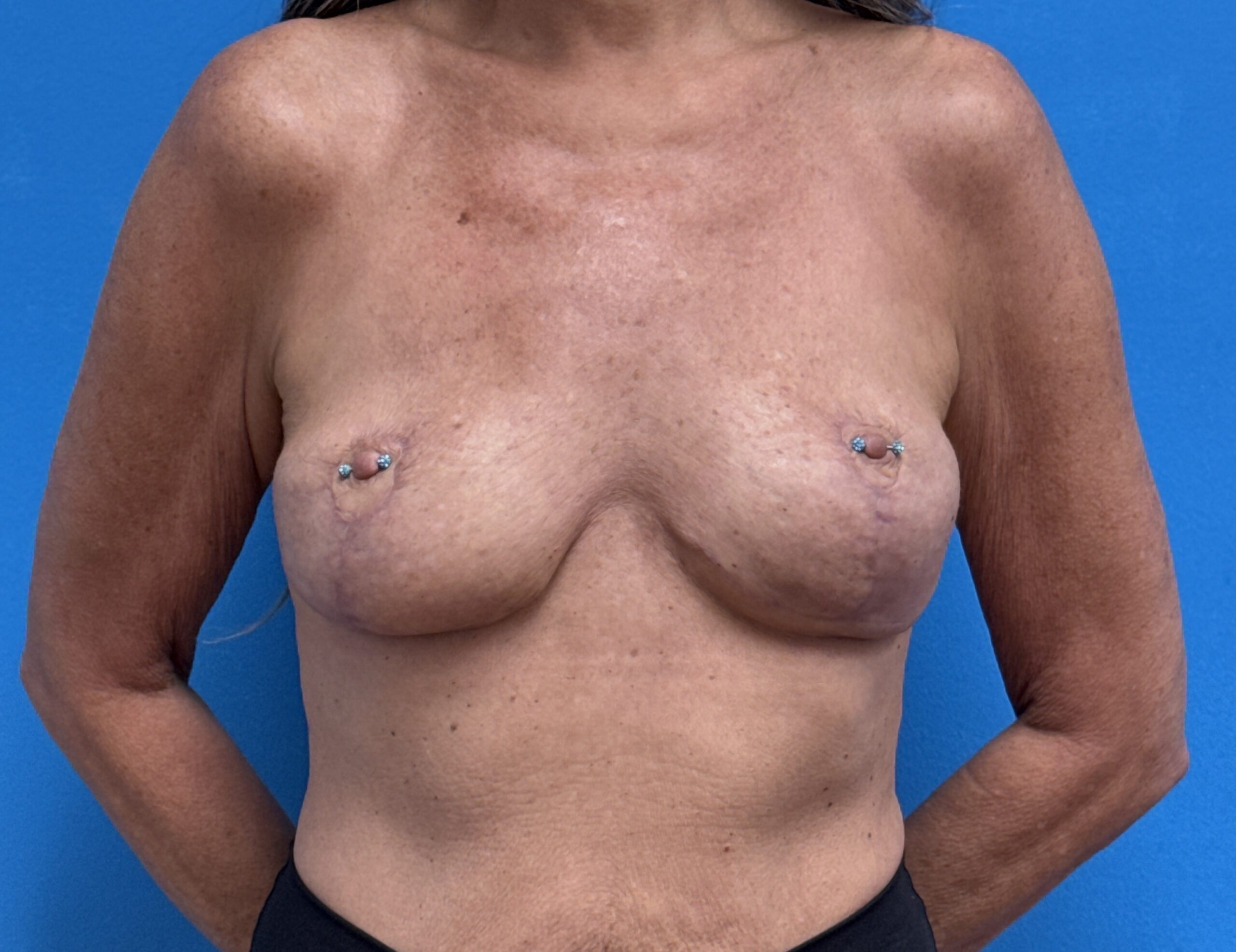 02182025 183000 (1) Implant Removal Case 21