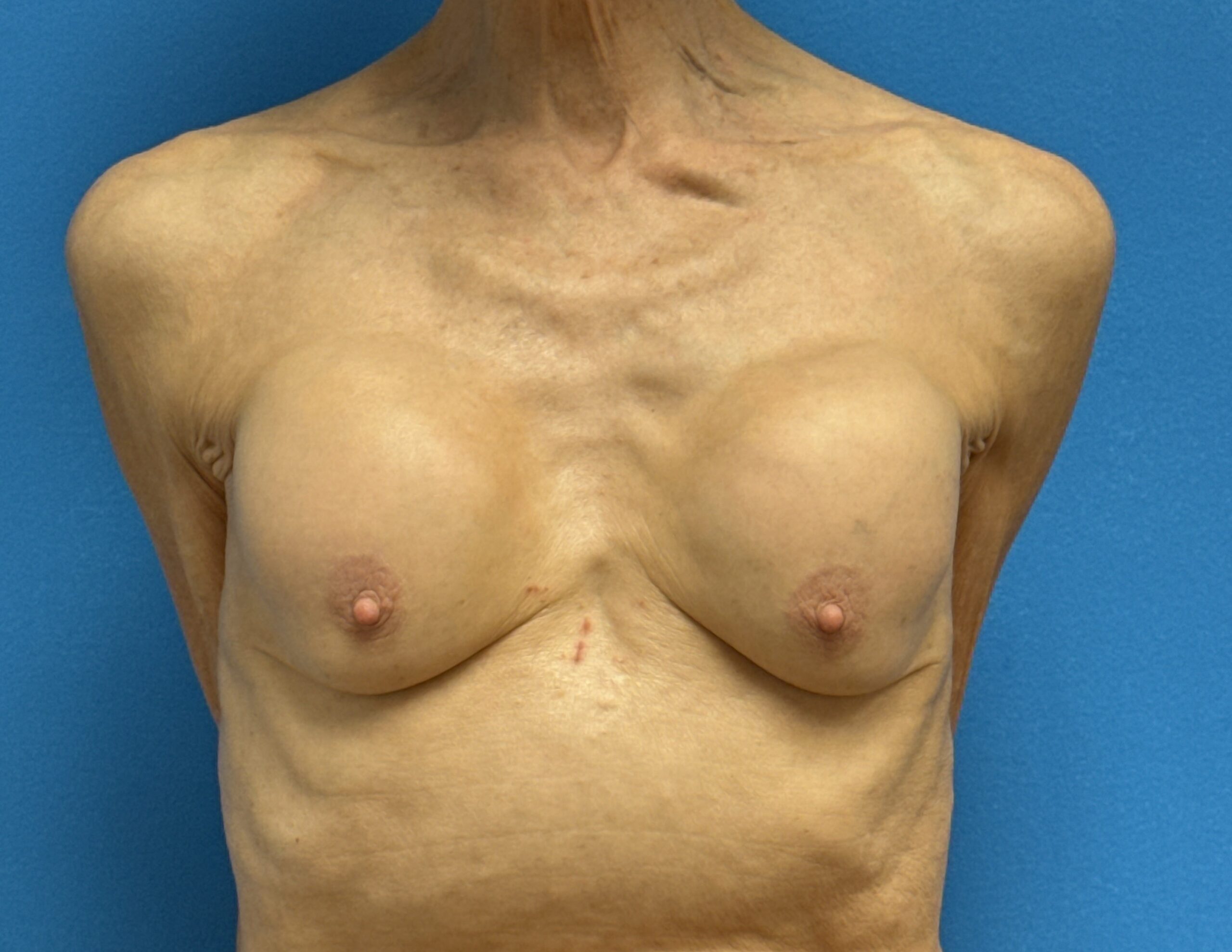 12122024 194400 (1) Breast Implant Revision/Replacement